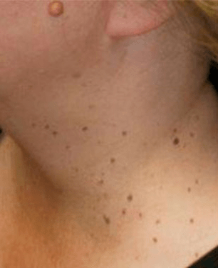 Papiloamele – cauze, tipuri, metode de tratament - Cancer