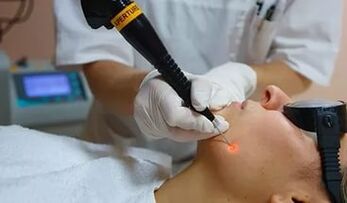 O procedură eficientă pentru îndepărtarea papilomului de pe față cu un laser