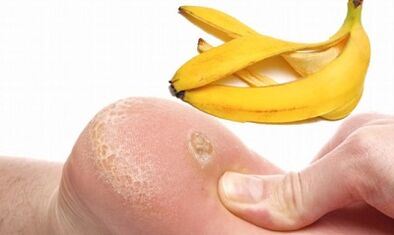 Coaja de banane pentru tratarea unei negi plantale