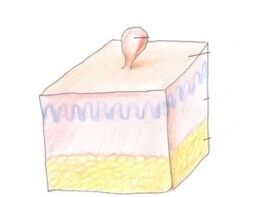 cum să scapi de papilomul de pe corp