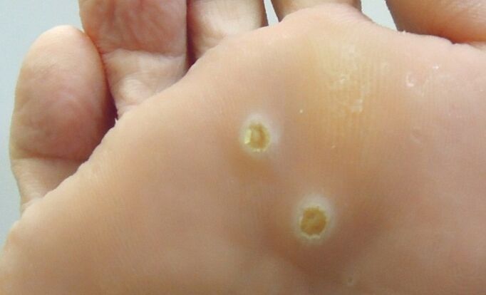 papiloame plantare pe picior
