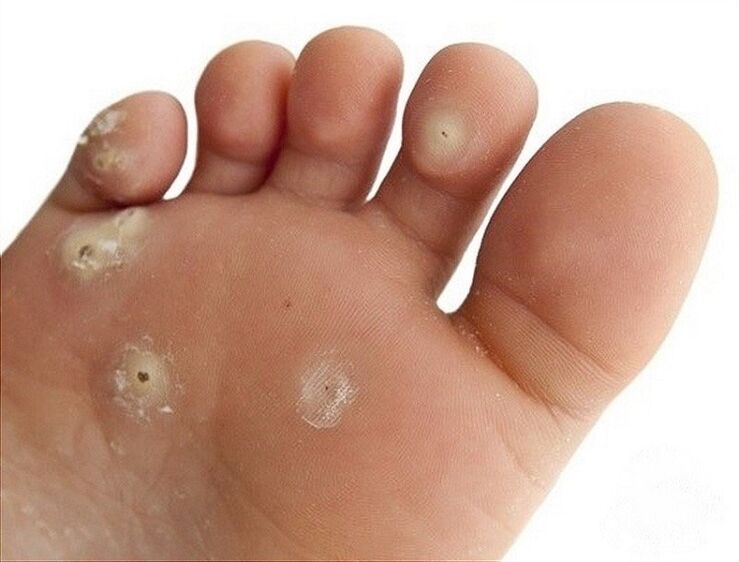 neg plantar