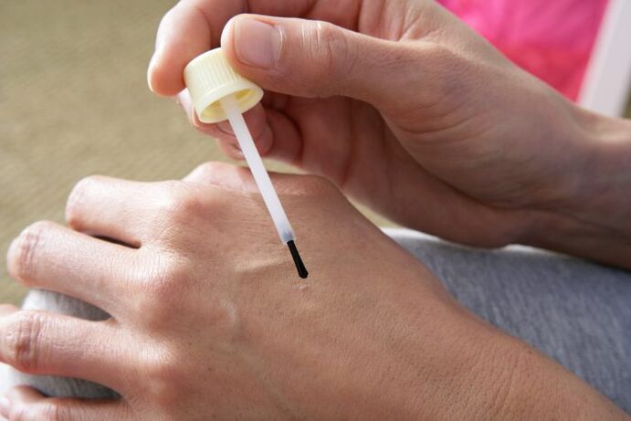 cauterizarea verucilor cu suc de celandină